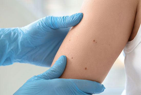 peau carcinome epidermoide