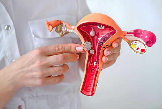 fibrome uterin