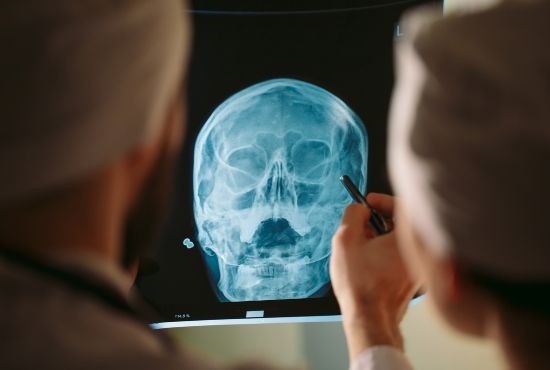 Un crâne d'une personne atteinte de la dysostose