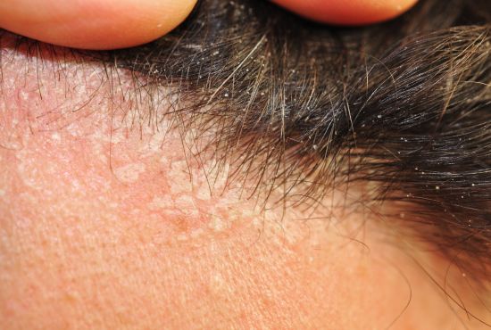 Homme atteint de dermatite séborrhéique