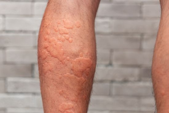 Jambe d'un homme atteint de vascularite.