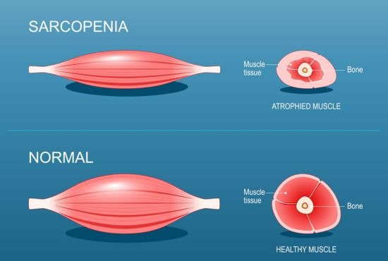 Schéma comparatif illustrant la sarcopénie : un muscle atrophié avec moins de tissu musculaire en haut, et un muscle sain avec un tissu musculaire dense en bas, montrant l'importance de prévenir la perte musculaire après 60 ans.