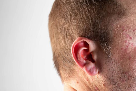 Gros plan sur le visage d'un homme présentant des rougeurs et des imperfections cutanées sur la joue et la tempe, illustrant les effets de l'alcool sur la peau et le vieillissement.