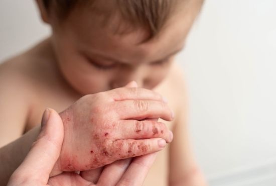 un enfant atteint de pyodermite