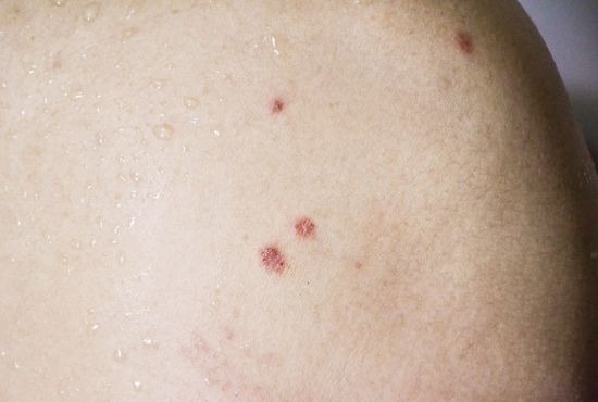 la peau d'une personne atteinte de la maladie de Bowen