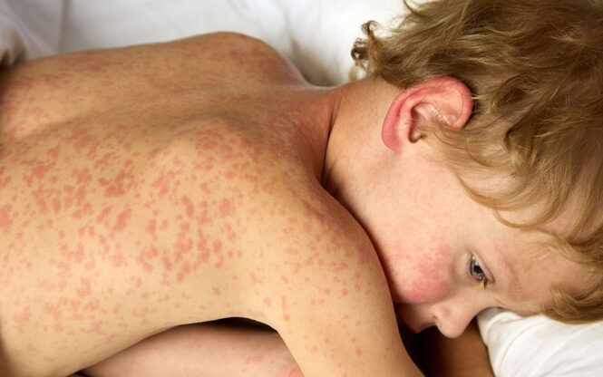 rubéole : comment la repérer et comment elle se transmet