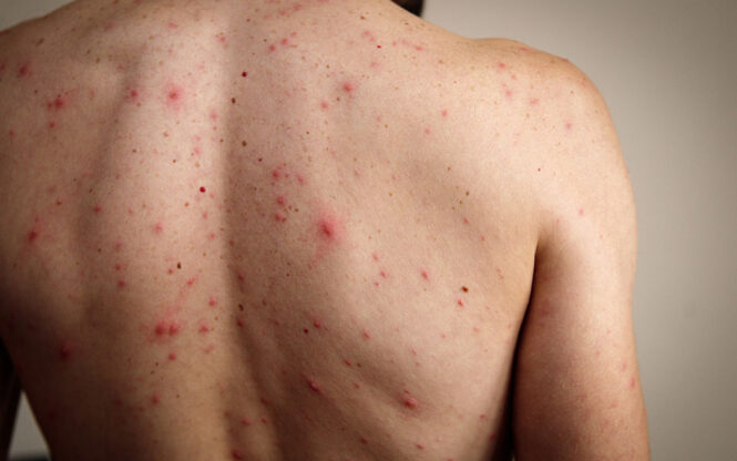 varicelle chez les adultes